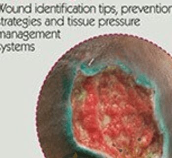 Is it a pressure ulcer or moisture-associated skin damage? Wound identification tips, prevention strategies and tissue pressure management systems - Heidi Huddleston Cross
